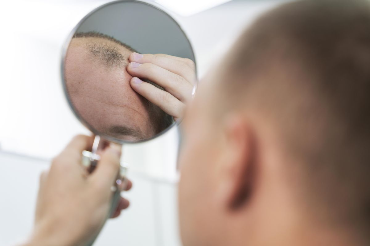 Botak Mendadak? Kenali Androgenetik Alopesia, Penyebab Rambut Rontok pada Pria & Wanita!