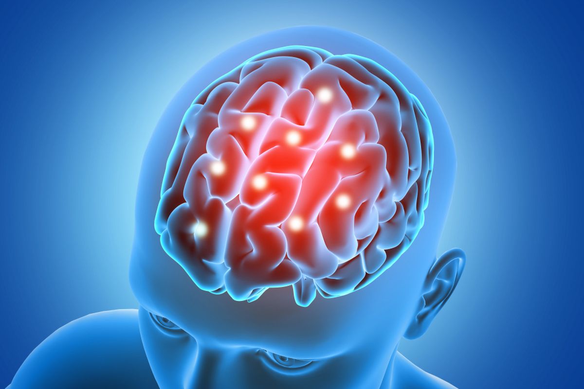 Kapan Pemeriksaan DSA Dibutuhkan untuk Diagnosis Stroke? Temukan Jawabannya!