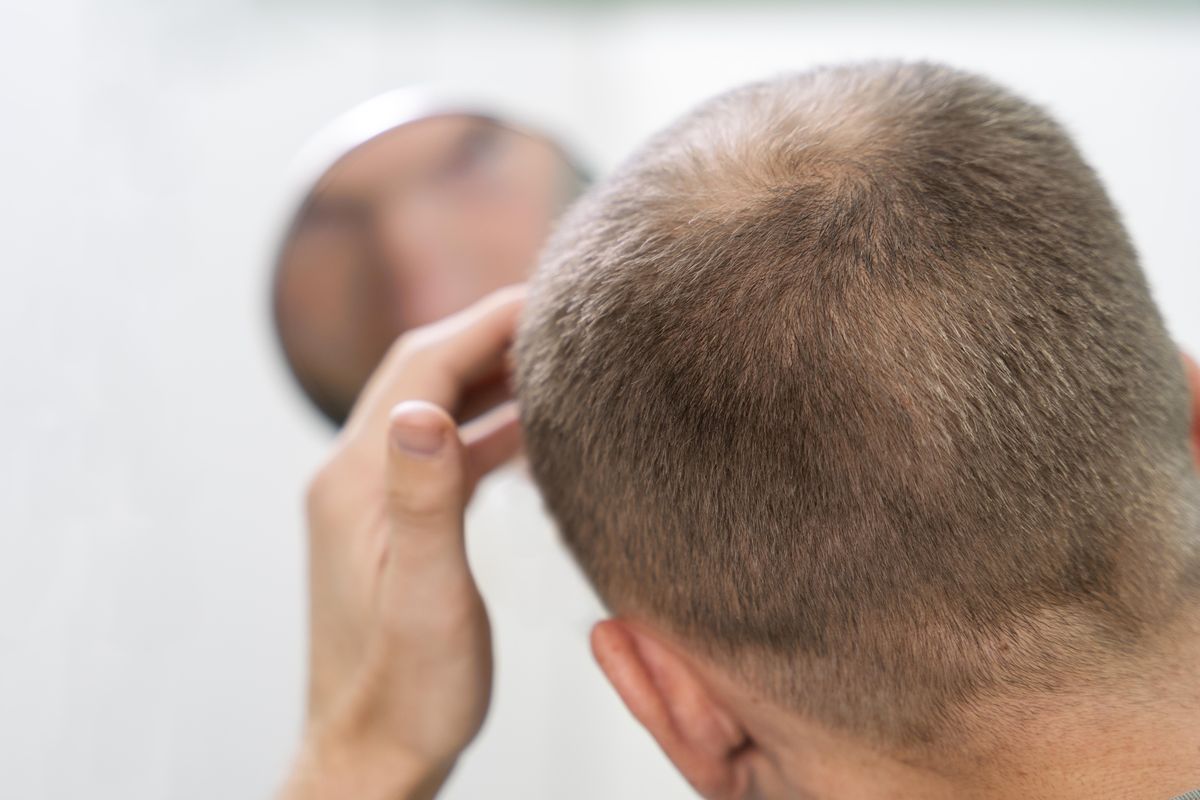 Korea Luncurkan Inovasi Revolusioner untuk Atasi Kerontokan Rambut Secara Efektif
