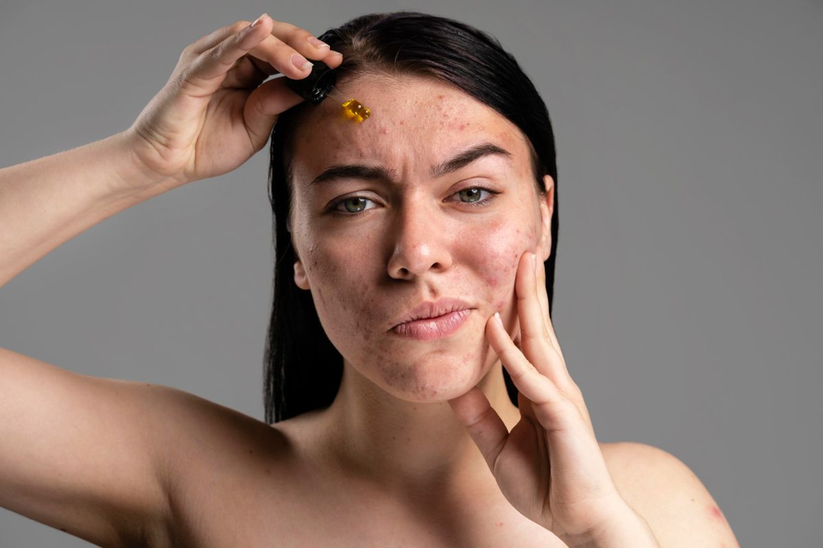 12 Kandungan Skincare Ampuh Atasi Flek Hitam, Termasuk Retinol!