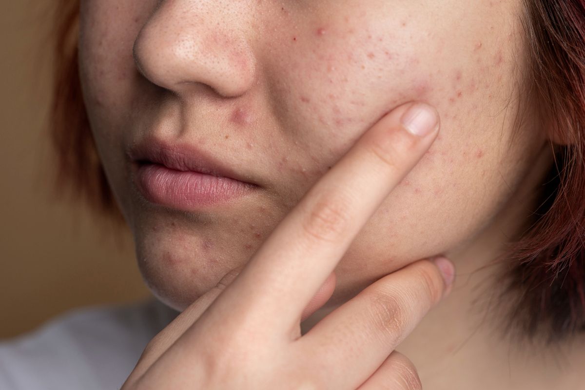 6 Kesalahan Skincare yang Memperparah Flek Hitam di Wajah & Cara Menghindarinya