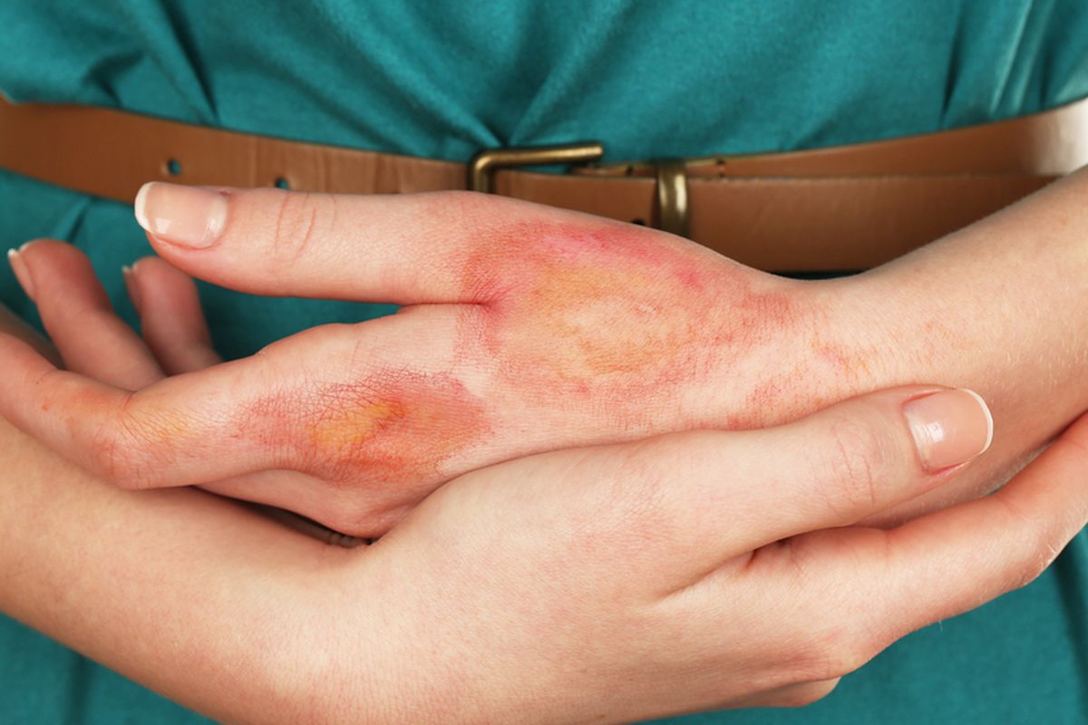 Benarkah Odol Bisa Sembuhkan Luka Bakar? Dokter Ungkap Fakta Mengejutkan!