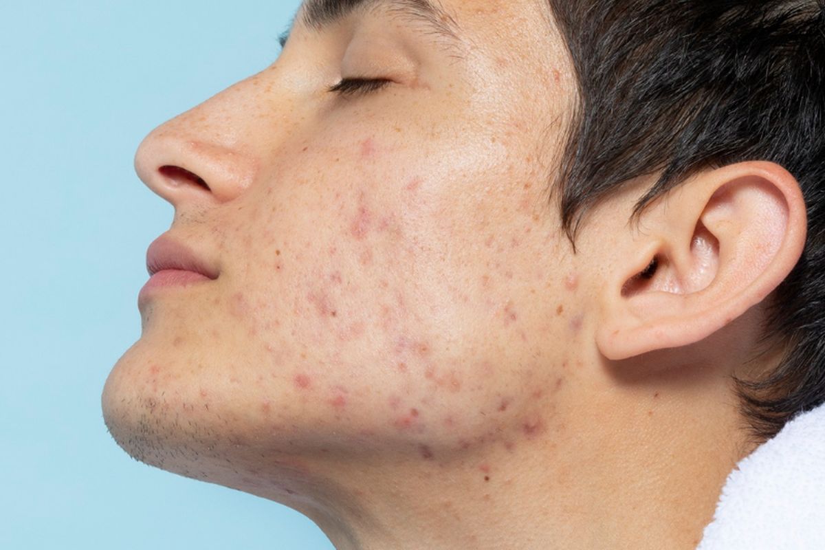 Waspada! Sering Ganti Skincare Ternyata Bisa Memicu Jerawat & Beruntusan, Simak Penjelasan Dokter